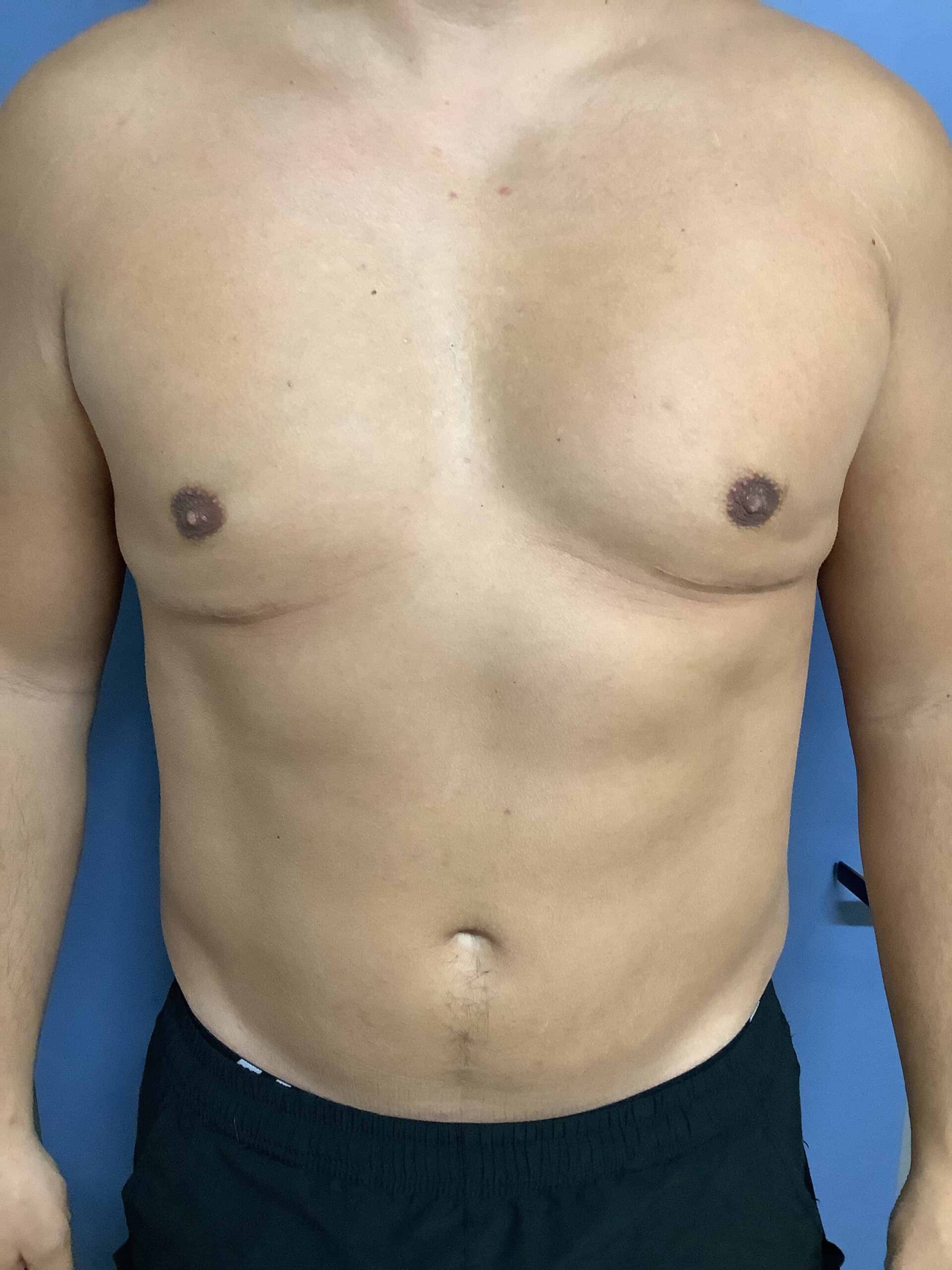 GYNECOMASTIA BEFORE & AFTER'S?