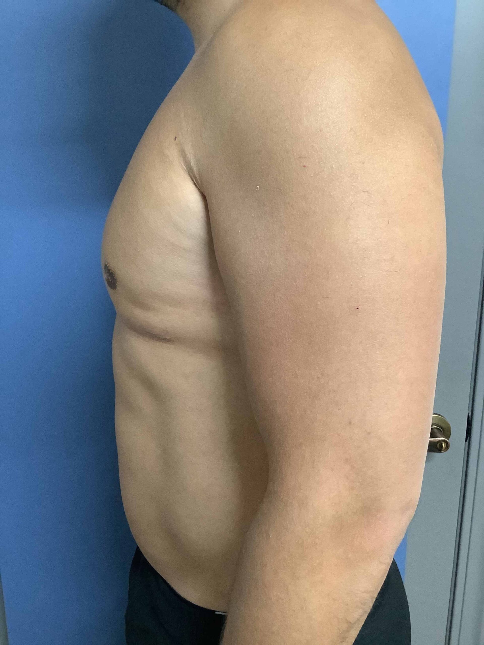 GYNECOMASTIA BEFORE & AFTER'S?