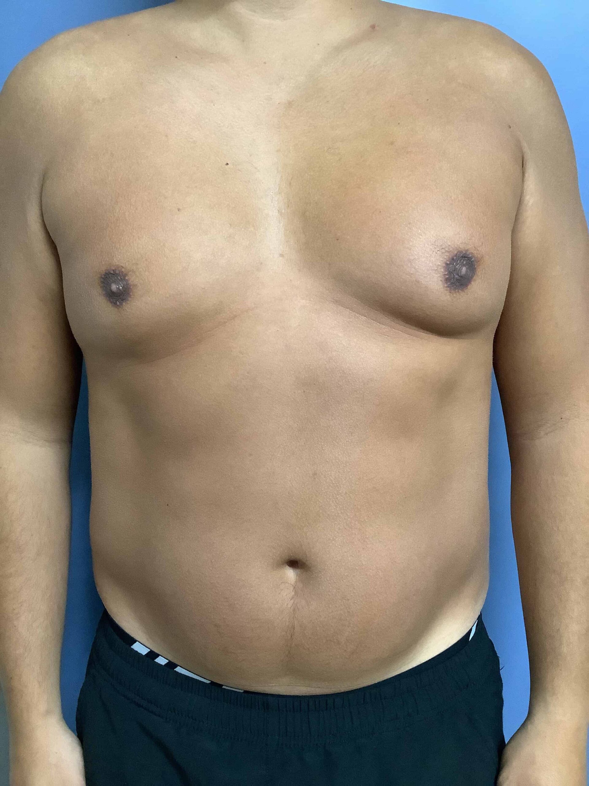 GYNECOMASTIA BEFORE & AFTER'S?