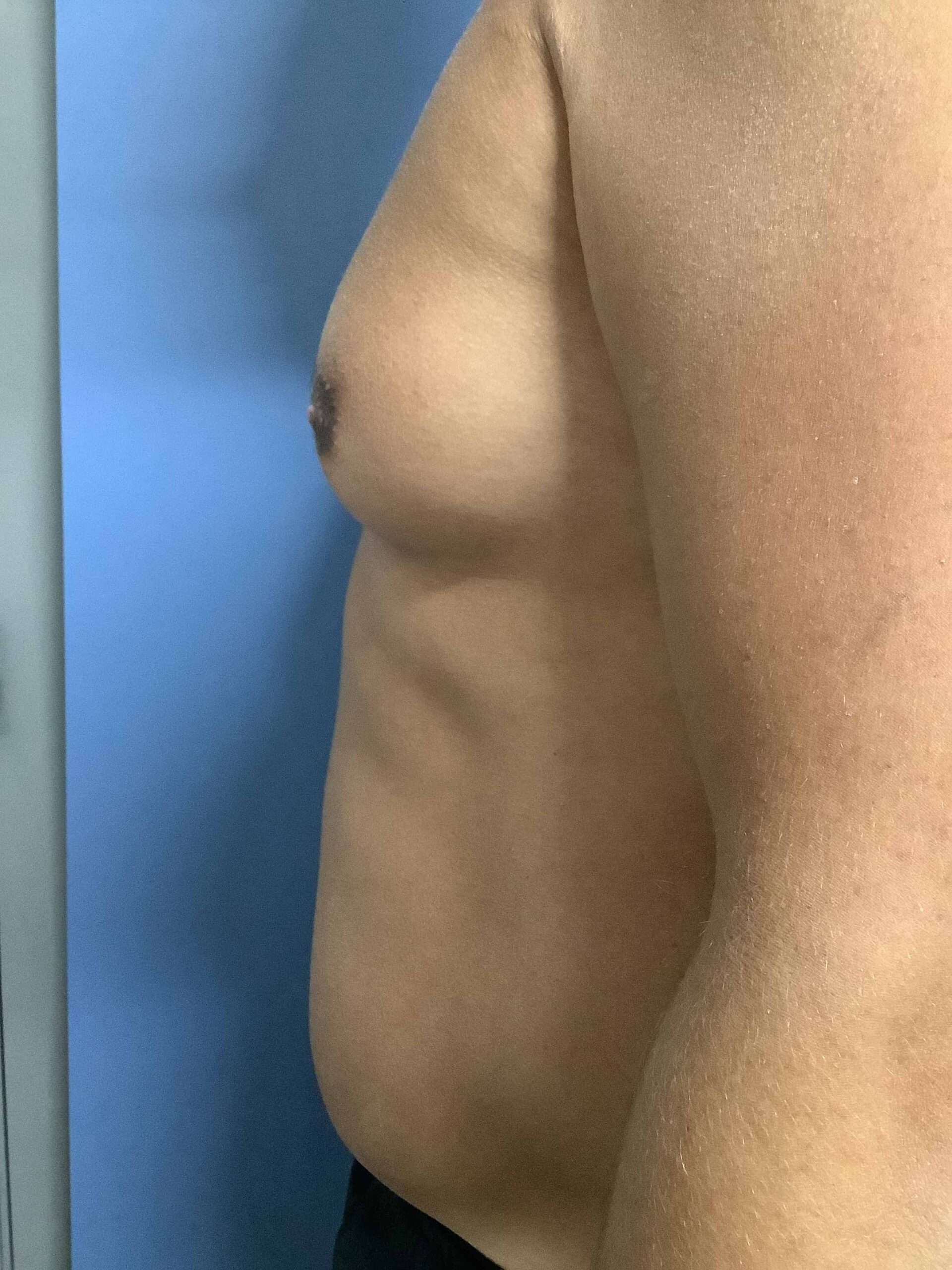 GYNECOMASTIA BEFORE & AFTER'S?